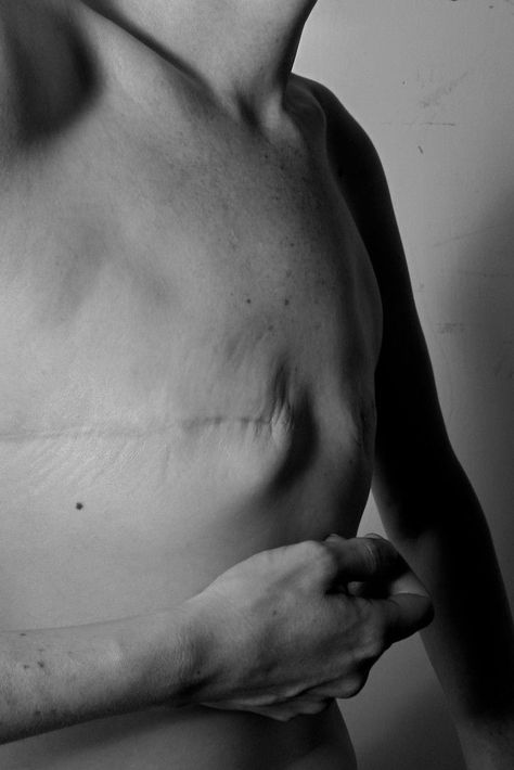 Mastectomy Scar Photoshoot, Double Mastectomy Photo Shoot, Post Mastectomy Photo Shoot, Flat Closure Mastectomy, Body Care Photography, Imperfection Photography, Scar Reference, Human Body Photography, Mastectomy Scars