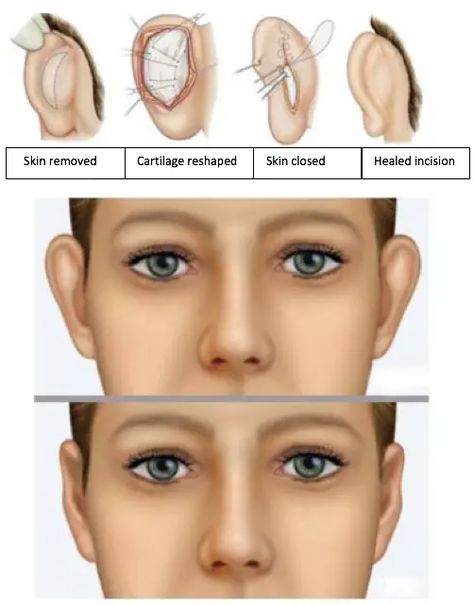 ear correction surgery in Lucknow Ear Pinning Surgery, Ear Surgery, Ear Structure, Facial Plastic, The Patient, Medical Illustration, Cosmetic Surgery, Body Mods, Low Cost