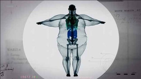 This image of an apparent X-ray of a 70-stone (980-pound) man has gone viral after trending heavily on Twitter . | This Is What A 980-Pound Man Looks Like On The Inside Big Boned, Respiratory Therapy, Radiology, Pisco, X Ray, Plastic Surgery, Take Care Of Yourself, Radios, Fitness Inspiration