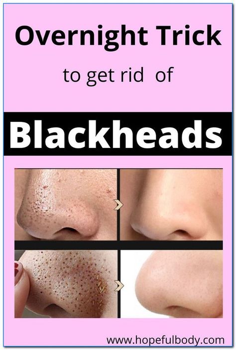 HOW TO REMOVE BLACKHEADS FROM NOSE & FACE Remove Blackheads From Nose, Blackhead Remover Diy, For Blackheads, Blackheads On Nose, Cold Medicine, Rid Of Blackheads, Choreography Aesthetic, Cold Sores Remedies, Remove Blackheads