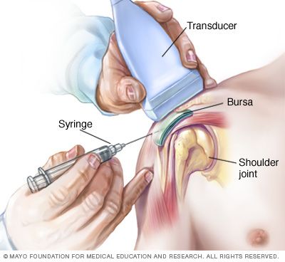 Bursitis Shoulder, Bursitis Hip, Shoulder Problem, Interventional Radiology, Shoulder Surgery, Rotator Cuff, Medical Anatomy, Medical Coding, Mayo Clinic