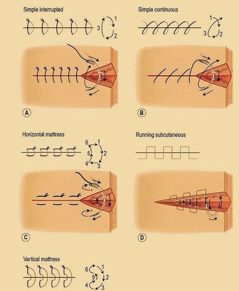 Useful Diagram ➡ Different Types Of Surgical Suture #doctor #medicine #medical #medschool #surgeon Veterinary Suture Patterns, Mortician Career Outfits, Sutures Types, Suture Types, Surg Tech, Nyttige Tips, Surgical Suture, Studera Motivation, Surgical Technologist