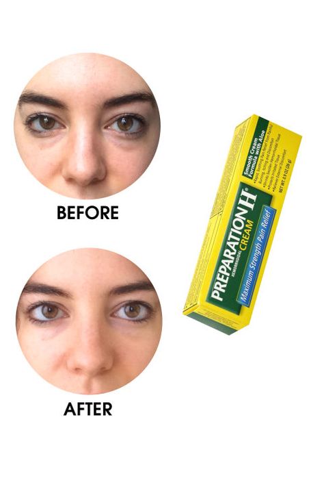 What's really the best way to depuff your eyes? An ELLE.com editor tests the most popular products, devices, and home remedies, documenting the befores and afters only through the unfiltered (and un-Facetuned) lens of an iPhone. The honest results of each, including Preparation H Hemorrhoidal-Cream Maximum Strength here. Preparation H, Bags Under Eyes, Dry Eyes Causes, Dark Circles Under Eyes, Under Eyes, Remove Dark Circles, Under Eye Bags, Puffy Eyes, Eye Bags