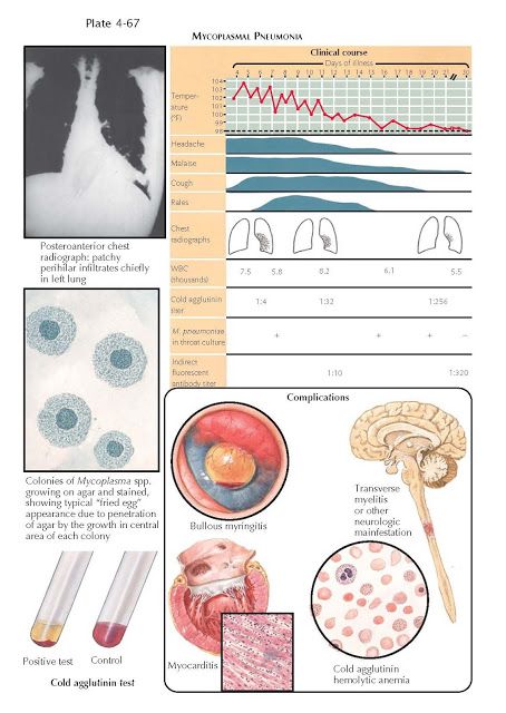 MYCOPLASMA PNEUMONIA Mycoplasma Pneumonia, Remedies For Pneumonia, Home Remedies For Allergies, Home Remedies For Warts, Warts Remedy, Natural Remedies For Migraines, Dry Skin Remedies, Cell Wall, Cold Home Remedies