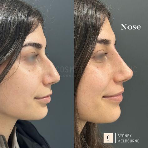 Our non-surgical rhinoplasty is a 15-minute injectable procedure that immediately improves the appearance of your nose. It’s a highly effective solution that can: - Hide bumps and humps - Lift and refine your nose tip - Slim and define your nose bridge - Balance the shape and size of your nose - Straighten a crooked nose - Improve poor surgical rhinoplasty results ⁠ Did you love this result? Want to know if it's right for you? Comment 'NOSE' to claim your complimentary opinion. ⁠⁠⁠ This con... Non Surgical Nose Job, Neck Lift Surgery, Double Chin Reduction, Nose Fillers, Crooked Nose, Nose Tip, Chin Augmentation, Nose Reshaping, Nose Jobs