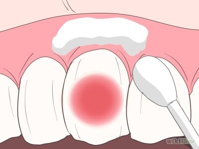 How to Stop Toothache Pain Fast -- via wikiHow.com