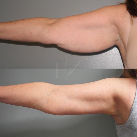 Arm Lift Surgery, Body Lift Surgery, Thigh Lift, Beauty Maintenance, Arm Lift, Mommy Makeover, Arm Fat, Post Op, Clean Cotton