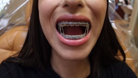 Cute Braces With Rubber Bands, Powerchain Braces Aesthetic, Braces With Rubber Bands, Powerchain Braces Color, Power Chain Braces, Braces Ideas, Braces Rubber Bands, Black Braces, Cute Braces Colors