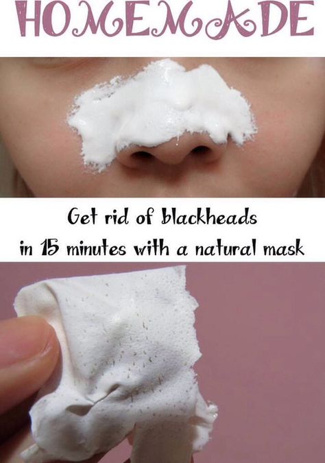 ✨Get Rid Of Blackheads In 15 Minutes With A Natural Mask!✨ Obličejové Masky, Make Up Diy, Natural Mask, Rid Of Blackheads, Face Mask Recipe, Get Rid Of Blackheads, Beauty Remedies, Homemade Face Masks, Homemade Face