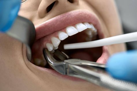 Tooth extraction is a form of oral surgery that involves removing a diseased or decayed tooth. We offer emergency tooth extraction and wisdom tooth extraction using the safest techniques in Houston. Dental Extraction, Tooth Pulled, Wisdom Tooth Extraction, Restorative Dentistry, Emergency Dentist, Tooth Extraction, Dental Cosmetics, General Dentistry, Dental Procedures