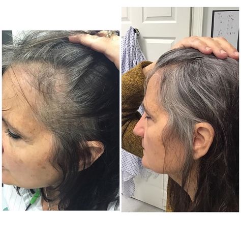 Hair Prp Before And After, Prp Hair Therapy Before And After, Minoxidil Before And After Women, Platelet Rich Plasma Therapy, Prp Therapy, Prp Hair, Hair Transplant Procedure, Platelet Rich Plasma, Hair Clinic