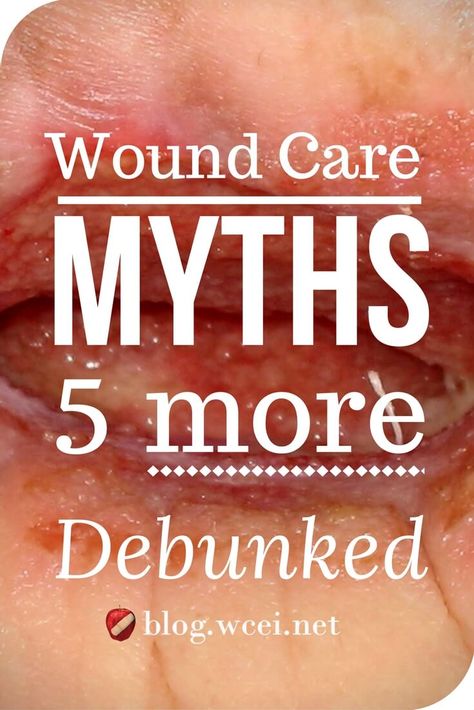 Wound Care Myths: 5 More Debunked - There are still plenty of wound care myths out there. Ready for the truth? You can handle it.  via @woundcareeducat Natural Wound Care, Heal Wounds Faster, Wound Care Nursing, Ostomy Care, Pressure Ulcer, Wound Dressing, Wound Care, Nursing Study, Wound Healing