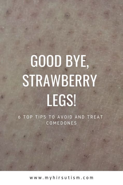 Comedones or strawberry legs are annoying. Here's how to get rid of them for good! Bumps On Legs Get Rid Of, How To Get Rid Of Shaving Bumps, Strawberry Bumps On Skin, Remove Strawberry Legs How To Get Rid, How To Remove Strawberry Legs At Home, How To Get Rid Of Strawberry Skin, Strawberry Legs Remedy How To Get Rid, Strawberry Skin How To Get Rid, Strawberry Legs Remedy