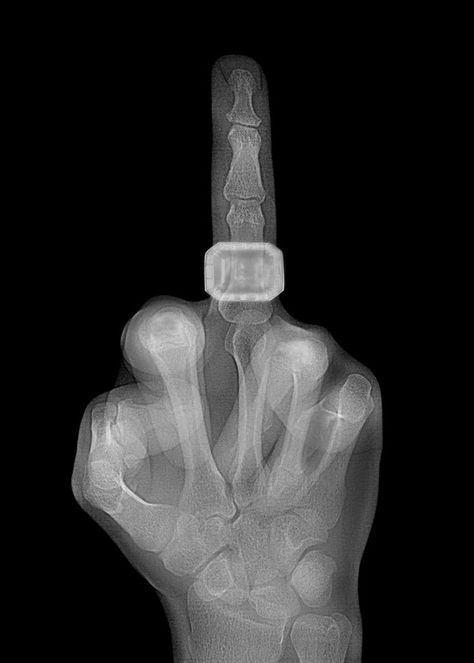 Mid Finger X-Ray in Black and White limited edition print 70x50 cm Rings Crown, Giving The Finger, Xray Art, Mid Finger, London Artist, The Other Art Fair, Bold Rings, Pop Art Print, Crown Ring