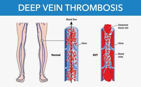 Deep Vein Thrombosis Disease with Causes and Nursing Intervention Leg Veins, Vein Thrombosis, Critical Care Nursing, Nursing Study, Critical Care, Healthcare Industry, Nurse Humor, Blood Flow, Nursing School