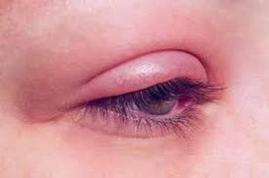 Blepharitis: why eyelids get red & itchy - NKCF.org Swollen Eyelids Remedy, Itchy Eyelids, Eye Health Remedies, Swollen Eyelid, Demodex Mites, Dry Eye Symptoms, Signs Of Inflammation, Swollen Eyes, Upper Eyelid