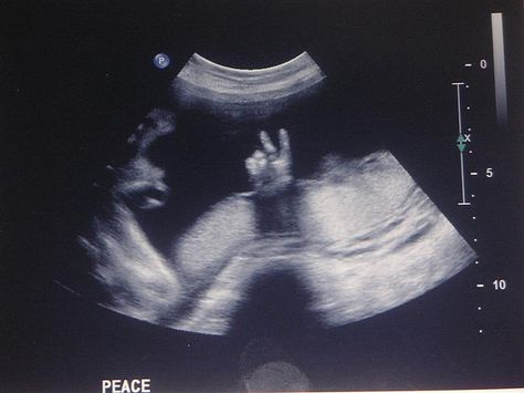 Peace on Earth... Boy Ultrasound, Funny Baby Boy, Baby Ultrasound, Ultrasound Pictures, Peace On Earth, Photo Op, Ultrasound, Nursery Rhymes, Funny Babies