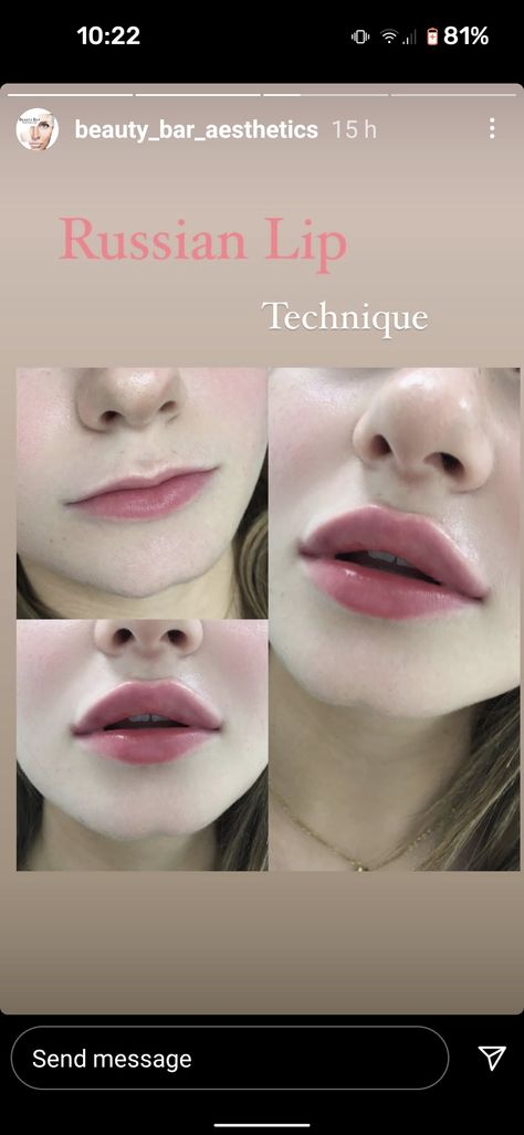 Hollywood Lips Filler, Lip Filler Round Lips, Russia Lip Filler, Lip Injections Aesthetic, Round Lips Aesthetic, Round Lips Filler, M Shaped Lips, Korean Lip Filler, Lip Fillers Before And After 1ml