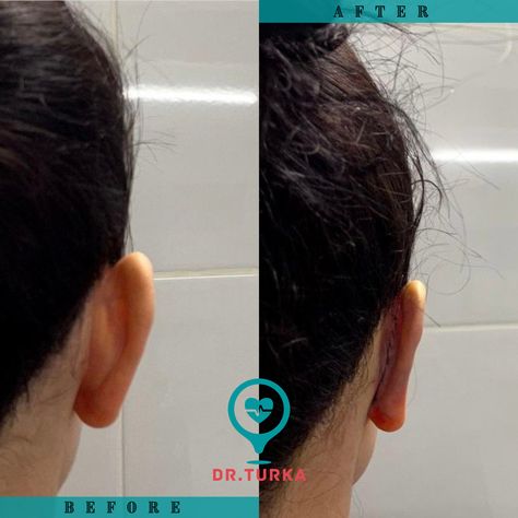 ✨Our dear patient from Malta🇲🇹had achieved Otoplasty (Cosmetic Ear Surgery). * 📲 +90 552633999 📩info@drturka.com 🌐www.drturka.com * #otoplasty #otoplastia👂 #otoplastia #otoplastysurgery #otoplastybeforeandafter #otoplastyturkey #earsurgerycosmetic #earsurgeryturkey #earssurgery #otoplastica #otoplastía #earsurgerycosmetic #otoplastyka #otoplasti #otoplastyistanbul Ears Pinned Back Before And After, Ear Surgery, Plastic Surgery, Malta, Surgery, Vision Board, Pasta, Quick Saves