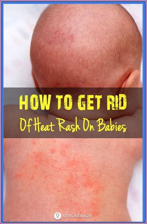 How To Get Rid Of Heat Rash On Babies Heat Bumps, Baby Heat Rash, Heat Rash Remedy, Home Remedies For Rashes, Rashes Remedies, Bad Acne, Heat Rash, Healing Remedies, Homemade Facials