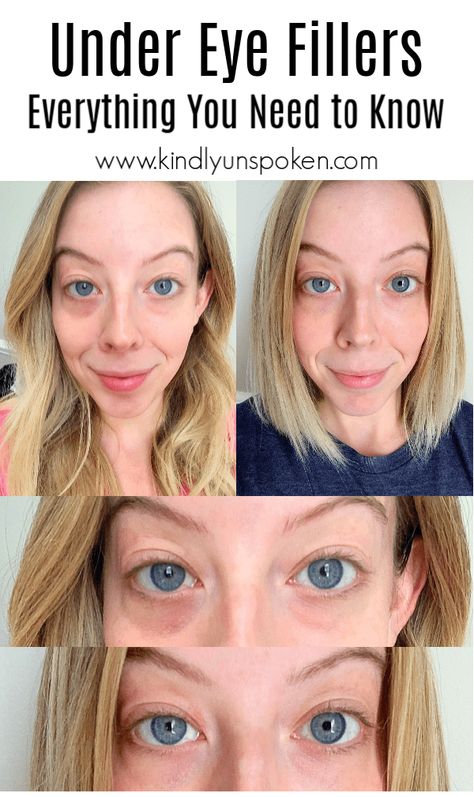 Voluma Cheeks, Juvederm Before And After, Botox Under Eyes, Hyaluronic Pen, Under Eye Filler, Eye Filler, Derma Fillers, Juvederm Voluma, Under Eye Fillers