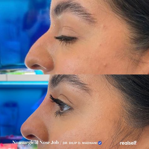 A nonsurgical nose job is much less invasive than traditional rhinoplasty surgery, but it’s not without risk. Liquid Nose Job, Liquid Rhinoplasty, Nonsurgical Nose Job, Crooked Nose, Rhinoplasty Surgery, Hyaluronic Acid Fillers, Facial Anatomy, Beauty Procedures, Facial Fillers