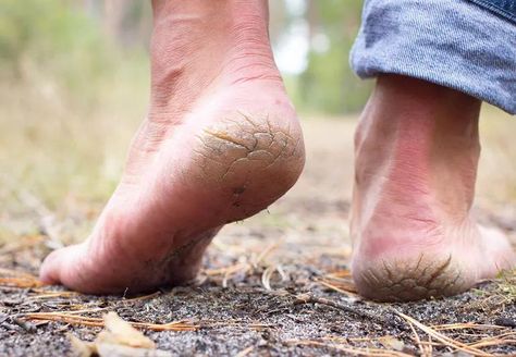 Ugh, there’s nothing like feeling a dry, sandpapery heel graze against your leg. But why do our heels become so rough and dry in the first place? A dermatologist shares how you can take dry heels from dusty and desert-like to satiny-smooth and sensational. Gentle Skin Care Routine, Heal Cracked Heels, Dry Heels, Full Body Cleanse, Dry Cracked Heels, Canker Sore, Gentle Skin Cleanser, Family Wellness, Cracked Heels