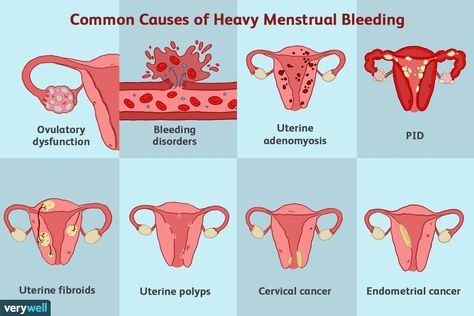 Pelvic Inflammatory, Uterine Polyps, Heavy Menstrual, Medical Memes, Hormonal Birth Control, Heavy Periods, Nursing School Notes, Period Pain, Menstrual Cramps