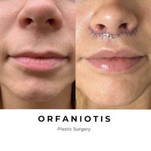 Lip Lift Before and After Gallery Lip Augmentation Before And After, Lip Lift Before And After, Lip Flip Before And After, Lip Plastic Surgery, Lip Lift Surgery, Lip Lift, Botox Before And After, Lip Augmentation, Celebrity Plastic Surgery