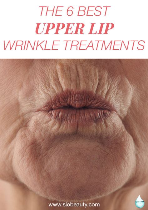 Lip lines or Lip wrinkle treatments. Tips to help get rid of smoker's lines #siobeauty #beautytips #skincare #skincareproducts Upper Lip Wrinkles, Smokers Lines, Mouth Wrinkles, Wrinkle Remedies, Lip Wrinkles, Skin Care Wrinkles, Deep Wrinkles, Upper Lip, Les Rides