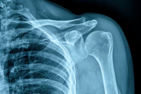 Photo of x-ray human shoulder X Ray Graphic Design, X Ray Aesthetic, Goggles Aesthetic, Medicine Art, Radiology Student, Xray Art, Ray Tattoo, X-ray Images, Circus Design