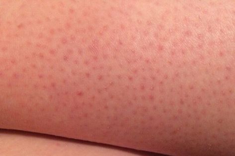 How to Get Rid of Strawberry Legs - The Beauty Goddess Strawberry Skin, Beauty Goddess, Strawberry Legs, Medical Terms, Oil Mix, Weird Things, Fed Up, Moisturizing Lotions, Aloe Vera Gel