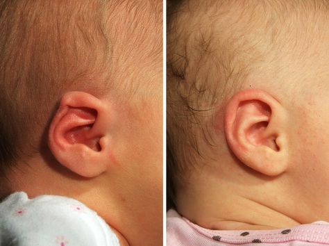 Before and after photos of an ear shaped with the EarWell device. Outer Ear, Evidence Based Medicine, Love And Logic, Helix Ear, Pointed Ears, Reconstructive Surgery, Baby Faces, Environmental Health, Cosmetic Procedures