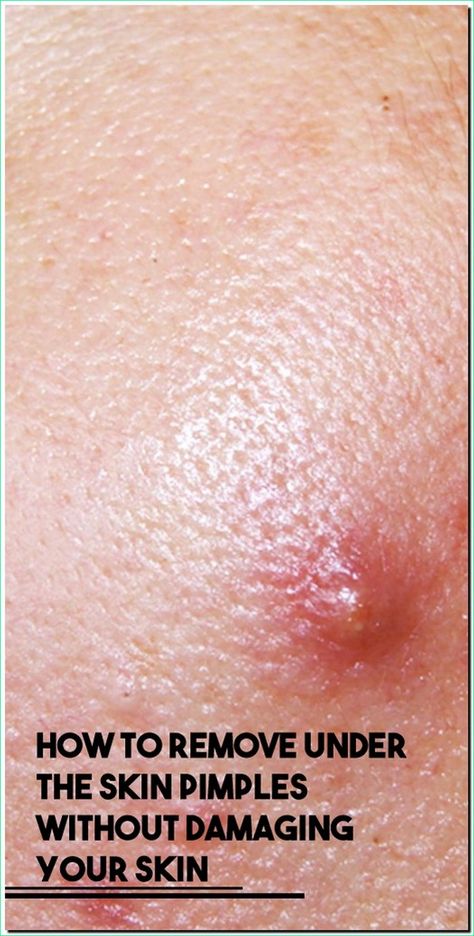 How To Remove Under The Skin Pimples Without Damaging Your Skin Pimple Meaning, Under The Skin Pimples, Blind Pimple, Pimples Under The Skin, Pimples On Face, Skin Natural Remedies, Under The Skin, Acne Cream, Health Remedies