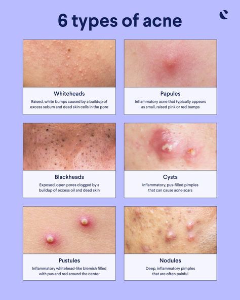 Acne Types, Nodule Acne, Different Types Of Acne, Mild Acne, Prevent Pimples, Pimples Under The Skin, Forehead Acne, Skin Advice, Severe Acne