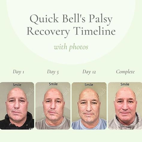 Bell’s Palsy, Bells Palsy, Warm Compress, Motor Neuron, Facial Nerve, Regency Dress, Facial Muscles, Muscle Relaxer, Facial Expressions