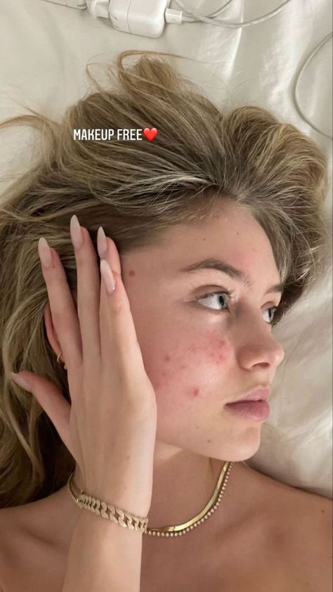 Girl With Acne Aesthetic, Spf Aesthetic, Sunscreen For Combination Skin, Sunscreen For Acne Prone Skin, Clear Skin Aesthetic, Sunscreen For Dry Skin, Sunscreen Aesthetic, Best Sunscreen For Face, Girl With Acne