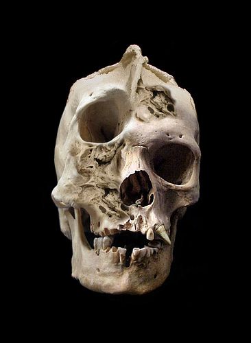 Adult human skull with severe craniofacial deformity. Skull Reference, Human Oddities, Seni 3d, Human Skull, Skeletal, Arte Horror, Human Anatomy, Skull And Bones, Skull Art