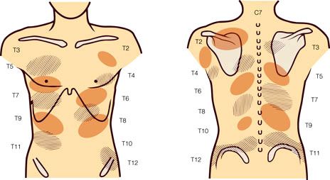 Dislocated Rib, Rib Pain, Synovial Fluid, Nerve Fiber, Protect Your Heart, Increase Heart Rate, Out Of Place, Trigger Points, Poor Posture