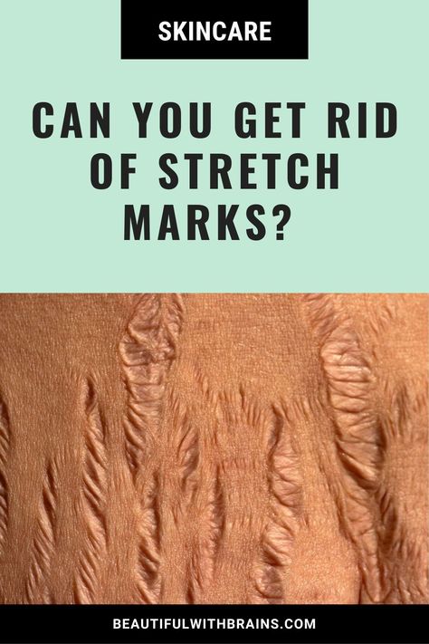 Unlock the Science. Say goodbye to stretch mark myths! Our article breaks down the science, offering practical methods for genuine improvement. Click through to discover realistic strategies without false promises. 🌟Try these Practical Tips Now! About: Stretch Marks, Skin Care False Promises, Strech Marks, Upper Lip Hair, Marks Cream, Stretch Mark Cream, Stretch Mark Removal, Stretch Mark, Lip Hair, How To Get Rid Of Acne