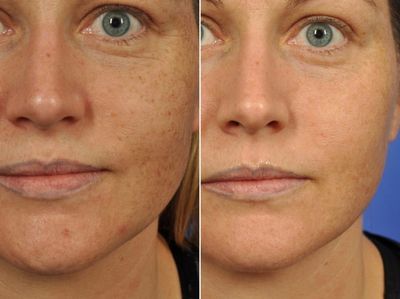 Clear and Brilliant Laser Resurfacing Before and After Photos in Plymouth, Pennsylvania, Patient 7737 I Heart Makeup, Laser Skin Resurfacing, Laser Resurfacing, Skin Resurfacing, Laser Skin, Large Pores, After Photos, Cosmetic Surgery, Plymouth