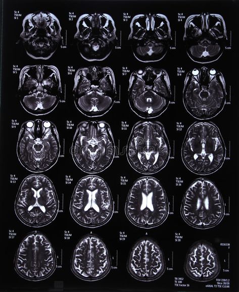 MRI scan image of brain stock photography Mri Brain, Brain Surgeon, Brain Images, Hospital Photography, Medical Wallpaper, Brain Anatomy, Brain Scan, Mri Scan, Brain Art