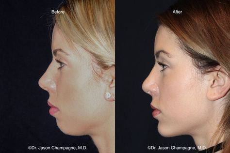 Chin Filler, Chin Augmentation, Chin Implant, Face Surgery, Facial Bones, Jaw Surgery, Facial Surgery, Facial Fillers, Nose Surgery