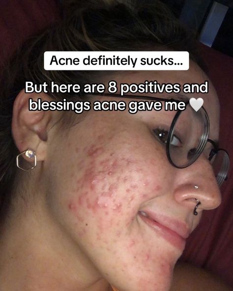 Thank you, acne 🤍. #adultacne #pcosacne #clearskin #glassskin #acnepositivity #acneneutrality What Does Acne On Your Chin Mean, Acne Supplements Clear Skin, How To Reduce Acne, Acne Confidence, Pretty People With Acne, Acne Pretty, Acne Is Normal, Acne Aesthetic, Acne Positivity