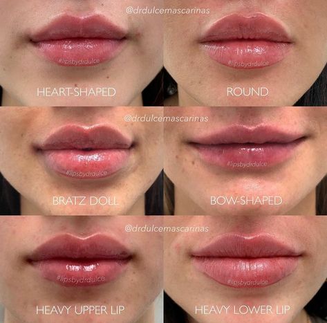 Gaun Koktail, Lips Inspiration, Face Fillers, Botox Lips, Being Unique, Facial Fillers, Flot Makeup, Facial Aesthetics, Botox Fillers