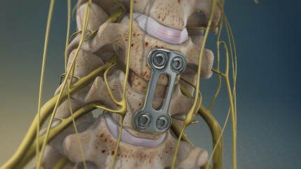 ACDF | Anterior Cervical Discectomy and Fusion | ACDF Spine Surgery Melbourne | Anterior Cervical Spine Surgery Spinal Nerves Anatomy, Nerves Anatomy, Acdf Surgery, Nerve Anatomy, Spinal Fusion Surgery, Cervical Disc, Intervertebral Disc, Spinal Fusion, Disk Herniation