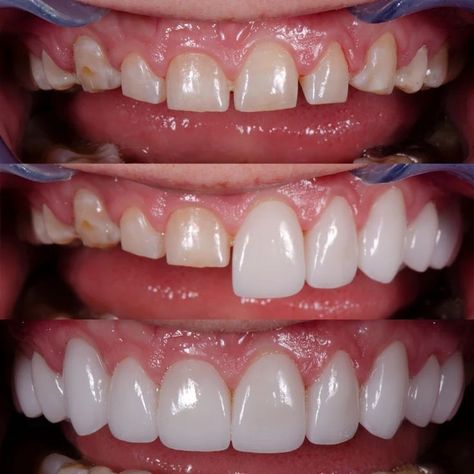 Dental Veneers Before And After, Dental Before And After, Porcelain Veneers Before And After, Dental Implants Before And After, Veneers Before And After, Veneer Teeth, Teeth Veneers, Dental Photos, Dental Images