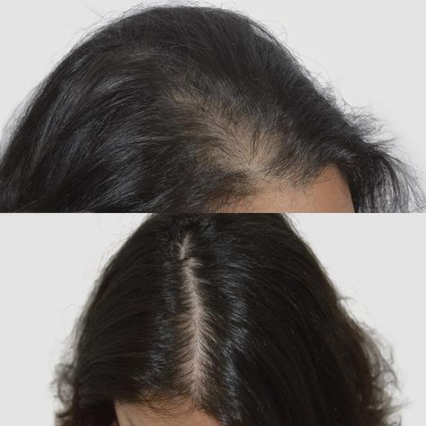 Female Gallery — Advanced Hair Restoration Hair Before And After, Hair Transplant Women, Arrow Image, Scalp Micropigmentation, Scalp Brushing, Women Health Care, Photo Restoration, Hair Reduction, After Pictures