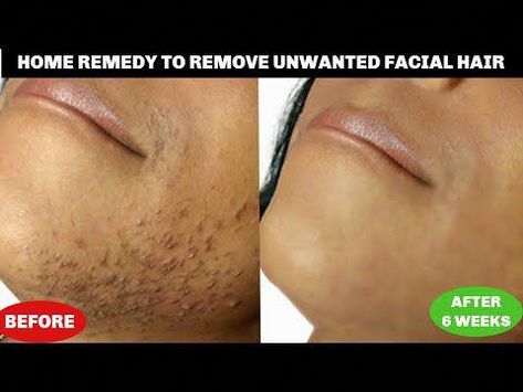 #Khichibeauty #khichibeautytipsGET RID OF UNWANTED FACIAL HAIR AT HOME, REMOVE CHIN HAIR + UPPER LIPS, NO SHAVE NO WAX25 DAYS SKINCARE CHALLENGE PLAYLISTht... Skincare Challenge, Waxing Vs Shaving, Natural Hair Removal Remedies, Chin Hair Removal, Female Facial Hair, Upper Lips, Upper Lip Hair, Bump Hairstyles, Face Hair Removal