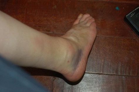 Ankle Sprain 2 | Ankle Sprain Second Degree, February 2011. … | Flickr Ankle Sprain Pictures, Sprained Ankle Snapchat, Sprained Ankle Remedies, Elide Lochan, Medicine Snaps, Ankle Sprain, Swollen Ankles, Musculoskeletal Pain, Chronic Kidney